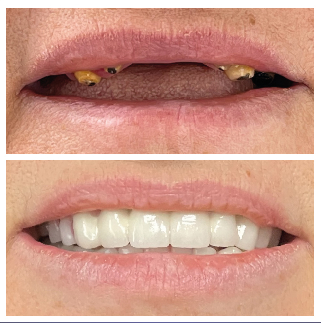 prosthesis and porcelain crowns