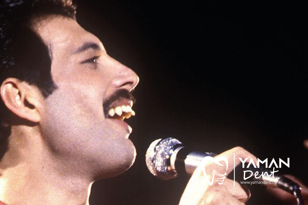 Freddy Mercury Teeth & Extra Teeth Yaman Dent