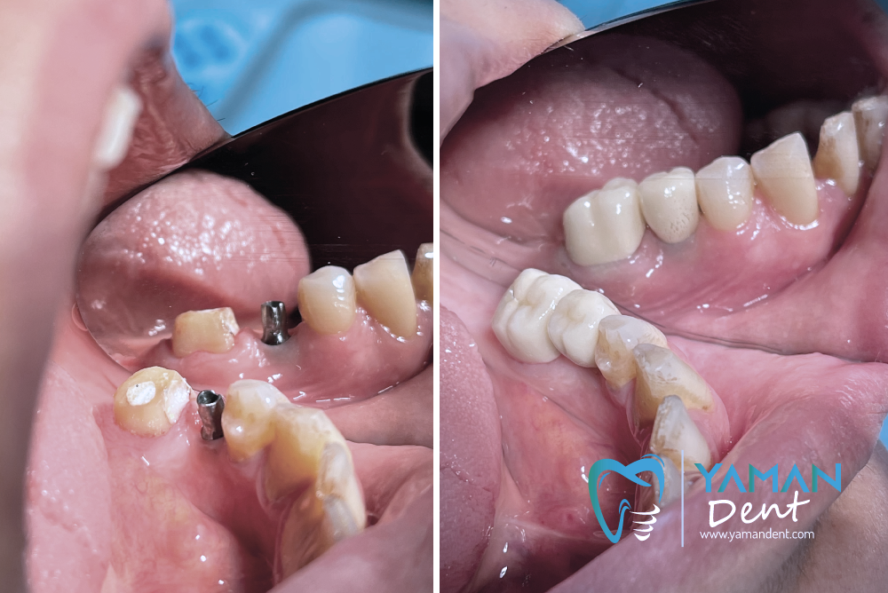 Dental Implants in Turkey - Packages and Prices | Yaman Dent
