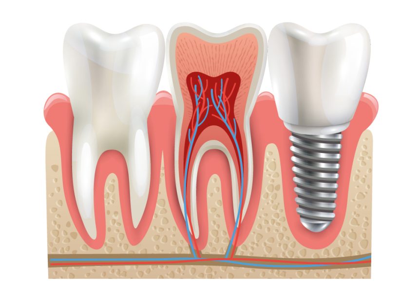 Implants vs. Crown Comparison: Pros & Cons Implants vs. Crown Comparison